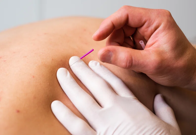 Dry needling